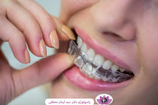 دندان قروچه چیست؟ راه‌های پیشگیری و درمان آن