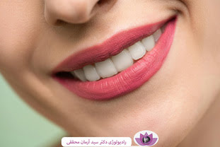 فرق کامپوزیت با روکش دندان: کدام گزینه برای شما مناسب‌تر است؟