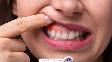 علت خونریزی لثه: دلایل، پیشگیری و درمان