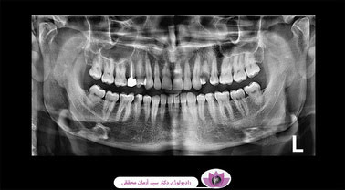 هزینه و کاربرد رادیوگرافی پانورکس (OPG)