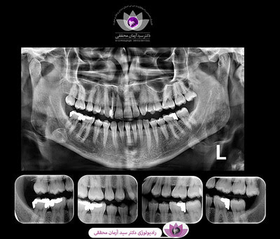 انواع رادیولوژی دندان و کاربردهای آن