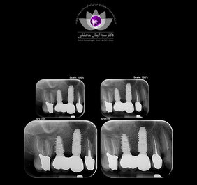 رادیوگرافی پری اپیکال چیست؟ کاربرد ها و مزایای آن در دندانپزشکی