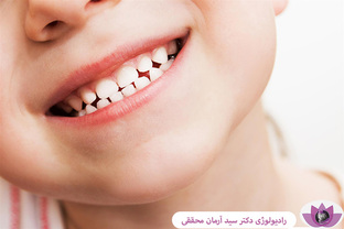 همه چیز درباره دندان شیری کودکان; زمان رشد و افتادن