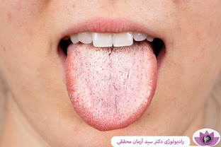 علت سفیدی زبان در طب سنتی و راهکار های درمانی