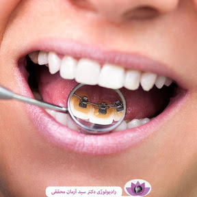 ارتودنسی از پشت دندان ها | ارتودنسی لینگوال