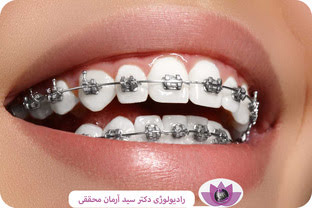 اجزای ارتودنسی و براکت های آن: معرفی کامل