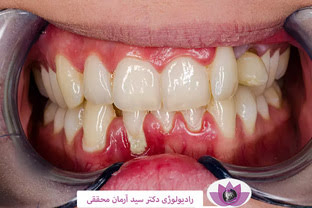 درمان التهاب لثه در زمان ارتودنسی